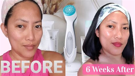 lumispa before and after acne|Improve Your Skin's Appearance with LumiSpa .